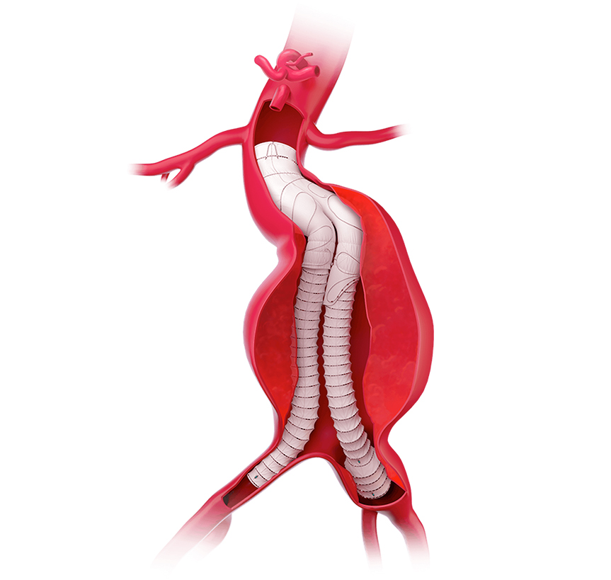 interventia endovasculara anevrismul de aorta abdominala